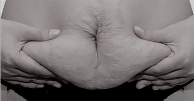 Rough and loose skin